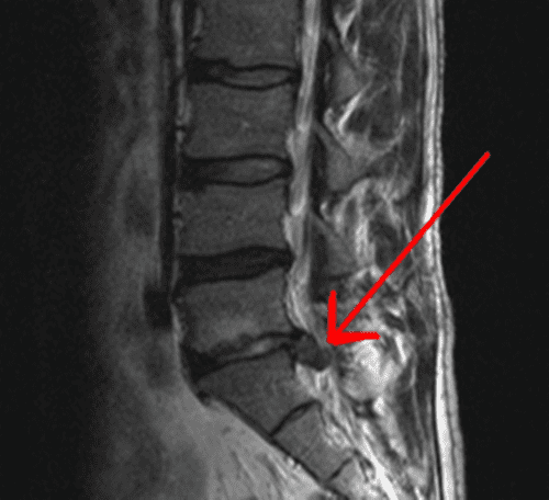 Sciatica MRI con ernia del disco | Chiropratico di El Paso, TX