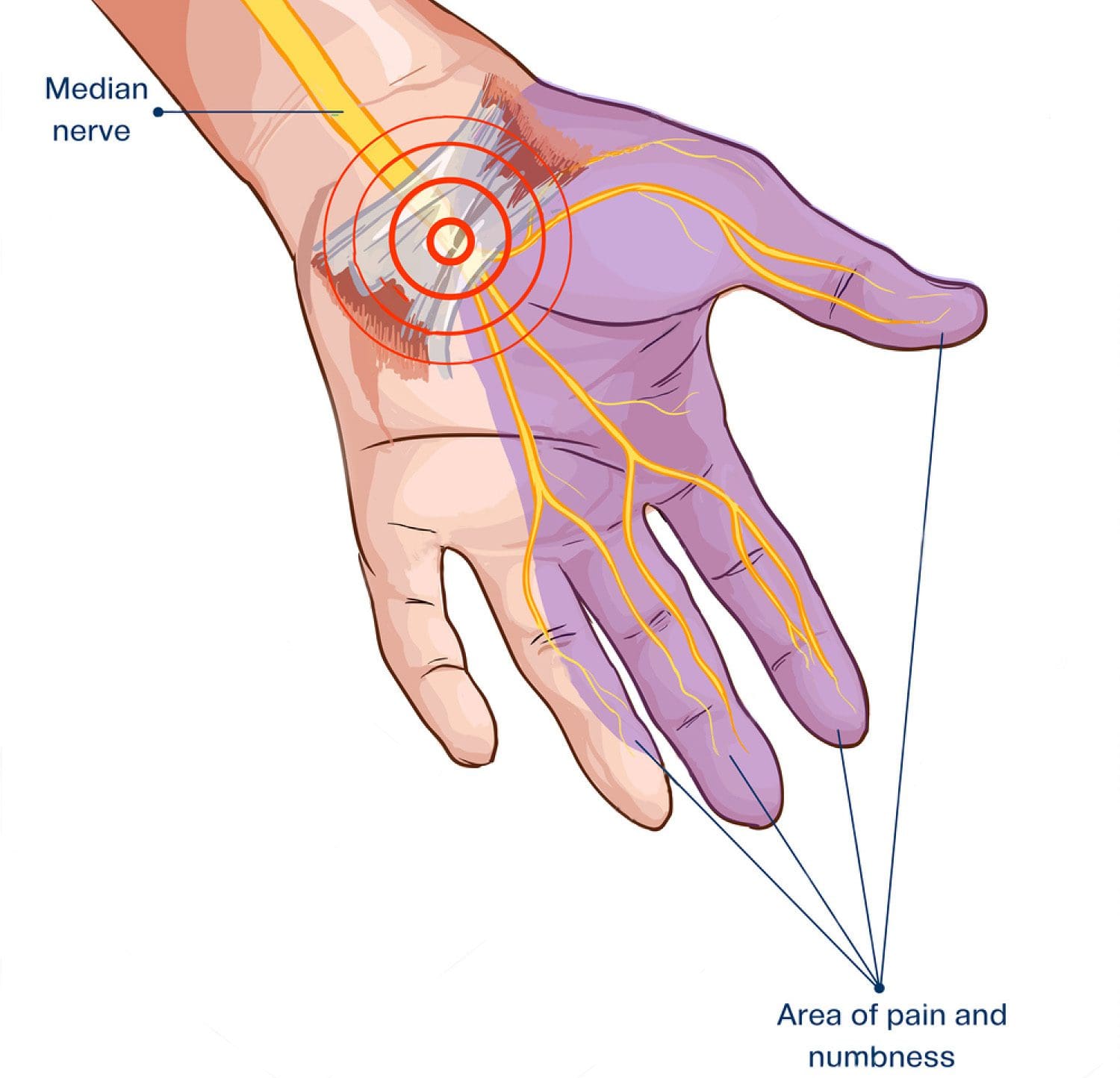 cts carpal tunnel syndrome el paso tx.