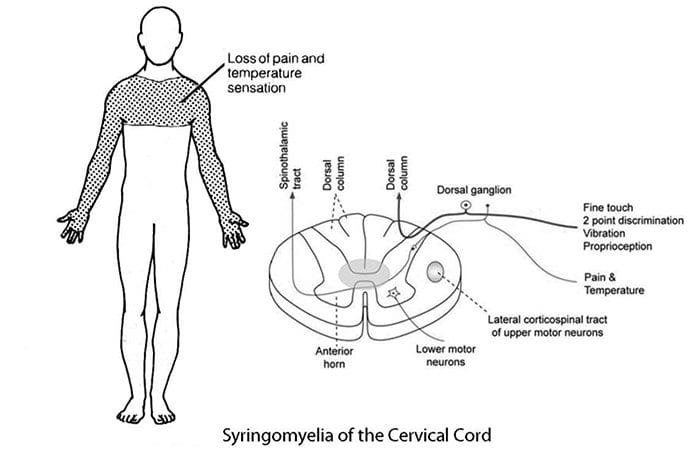 neuropathy isingeniso el paso tx.