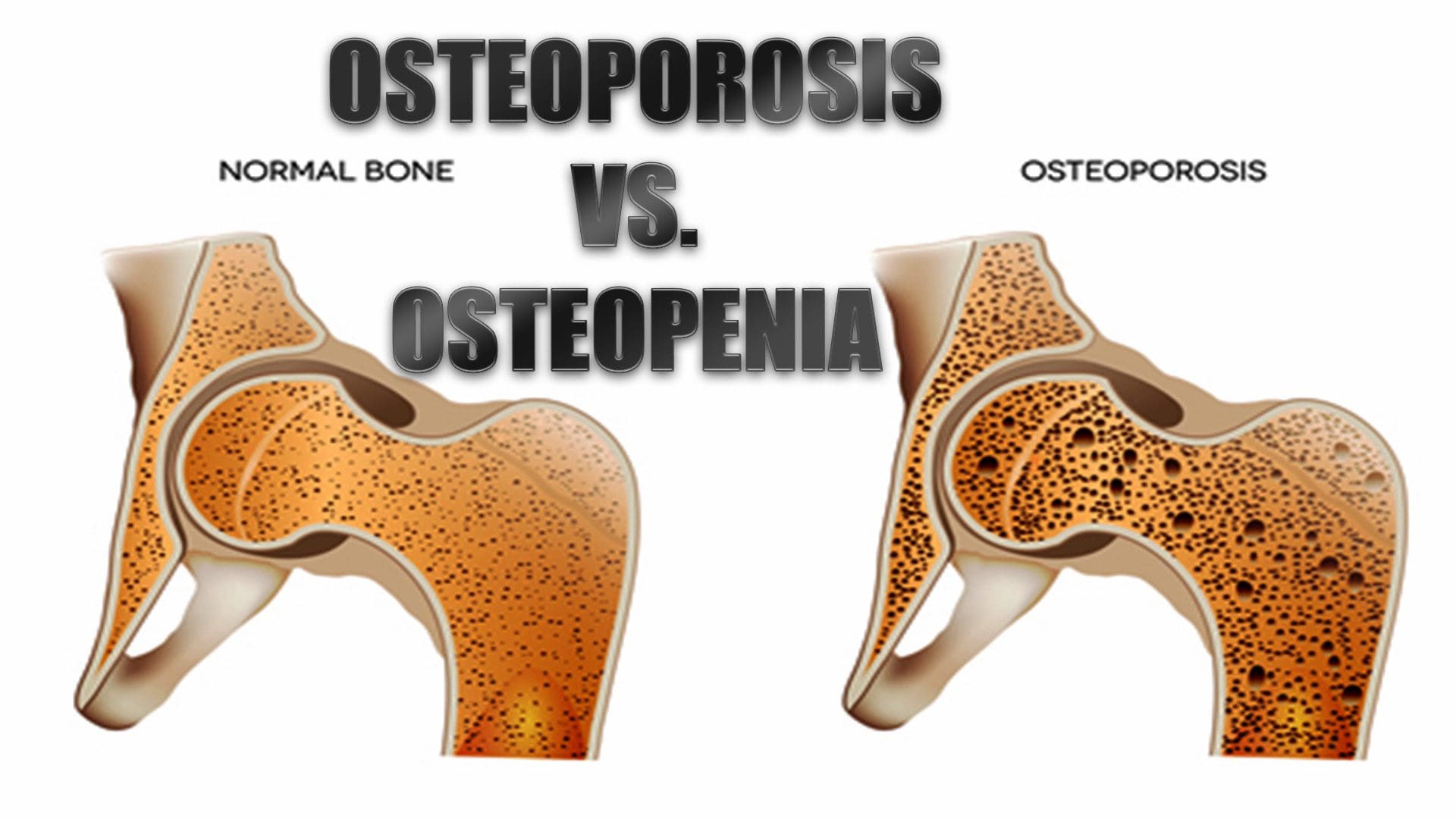 Osteoporosis essay