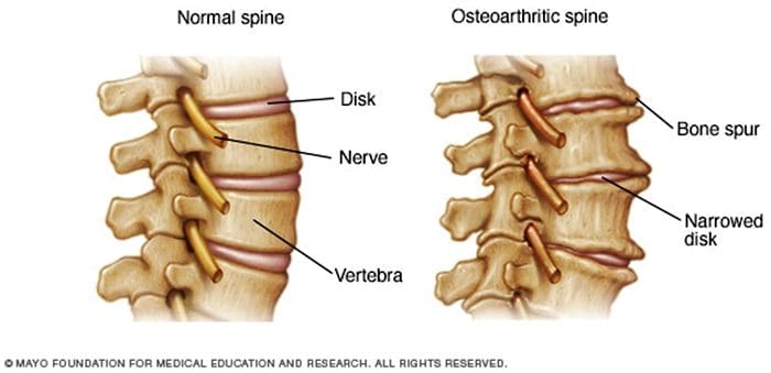 facetogenic neuropathic, osteoarthritis and headaches pain el paso tx.