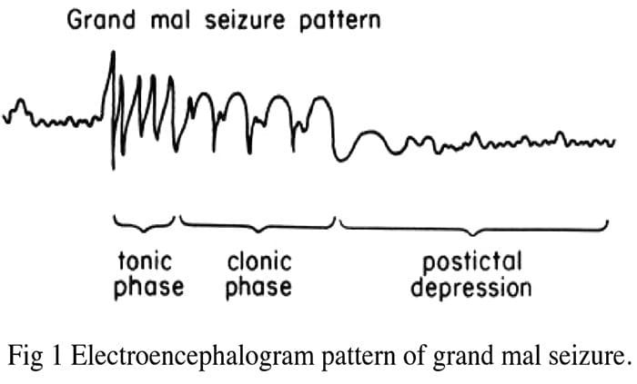 convulsiones epilepsia quiropráctica el paso tx.