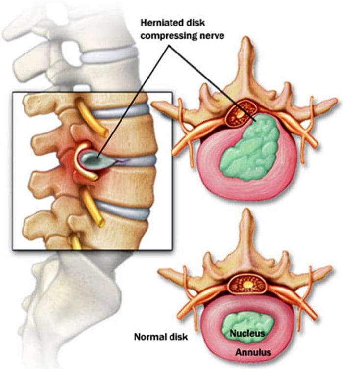 i-radiculopathies i-chiropractic care el paso tx.