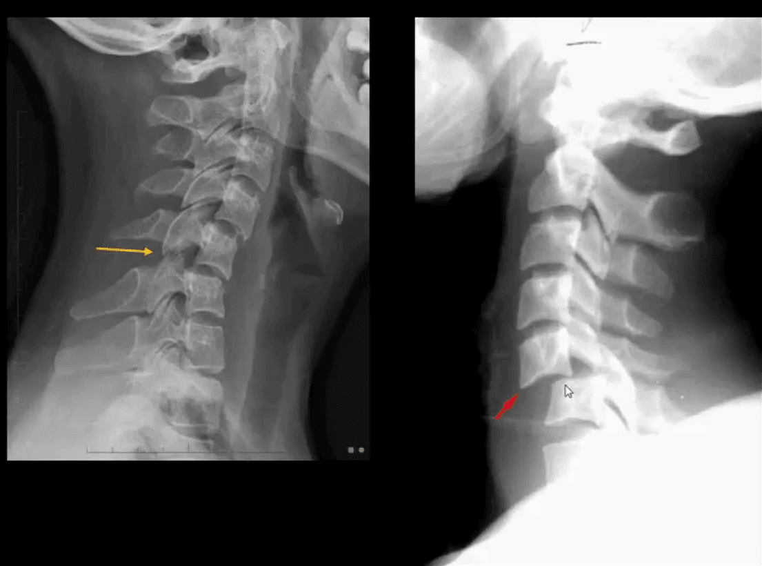 spinal trauma el paso tx.