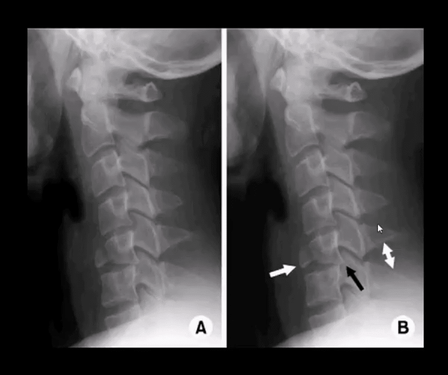 trauma spinale el paso tx.