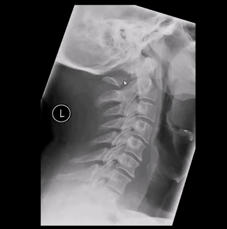 trauma spinale el paso tx.