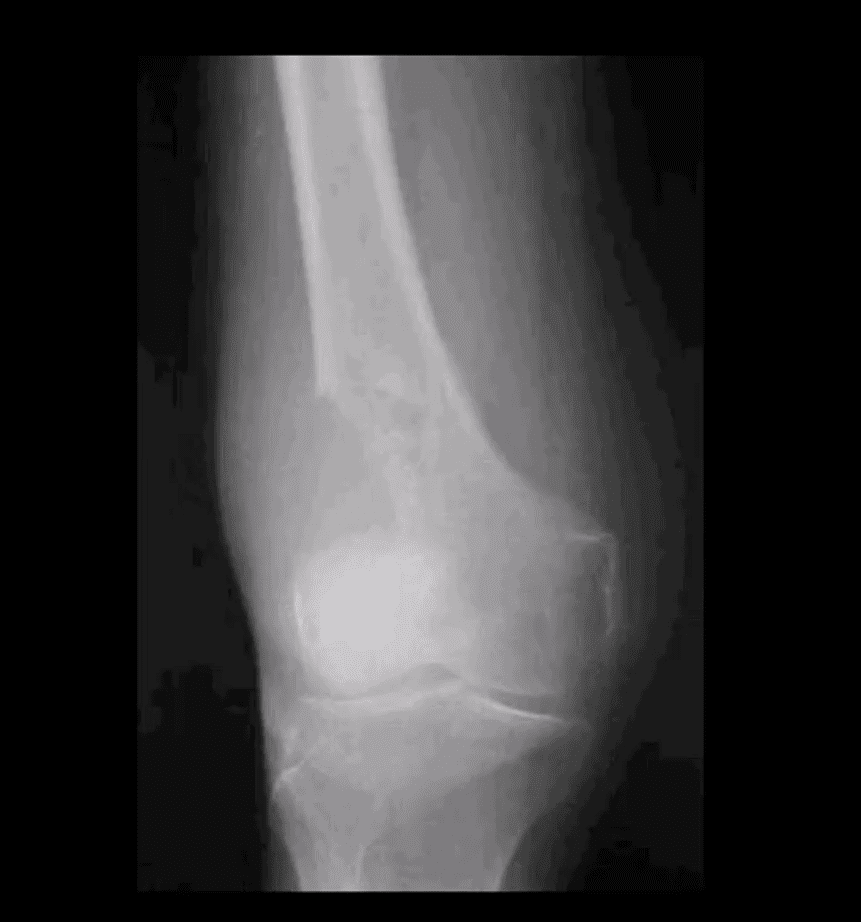 spinal neoplasms diagnostic imaging el paso tx.