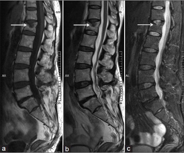 Vertebral Fracture Diagnosis Imaging Studies | El Paso, TX Chiropractor