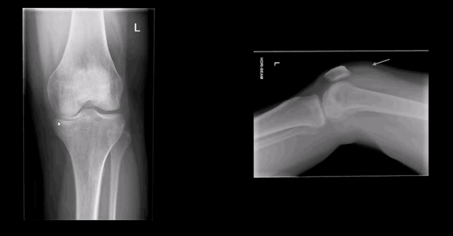 trauma agudo da dor do joelho el paso tx.