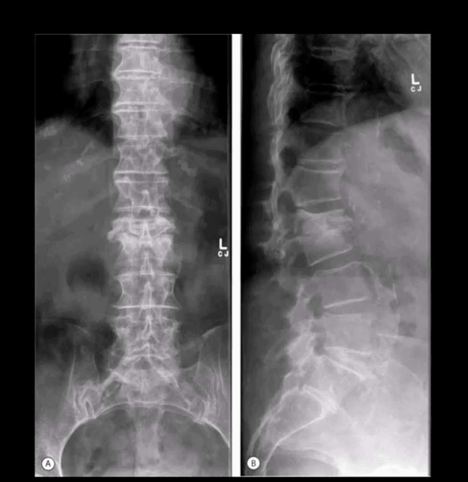 diagnóstico de infección espinal diagnóstico por imágenes el paso, tx.