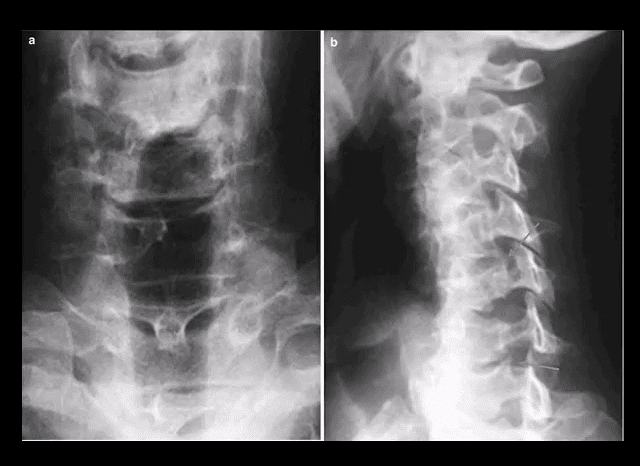 spinal arthritis el paso tx.