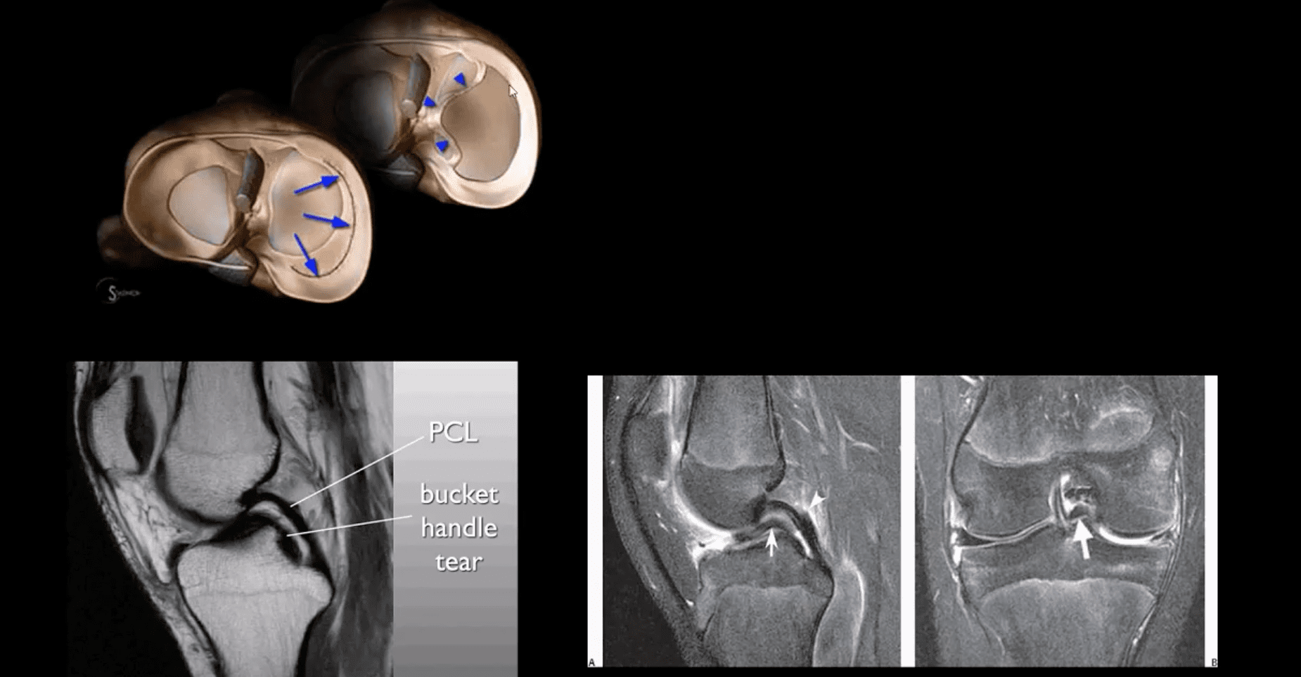 dolore al ginocchio trauma acuto el paso tx.