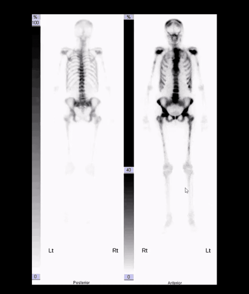 neoplasie spinali diagnostica per immagini el paso tx.