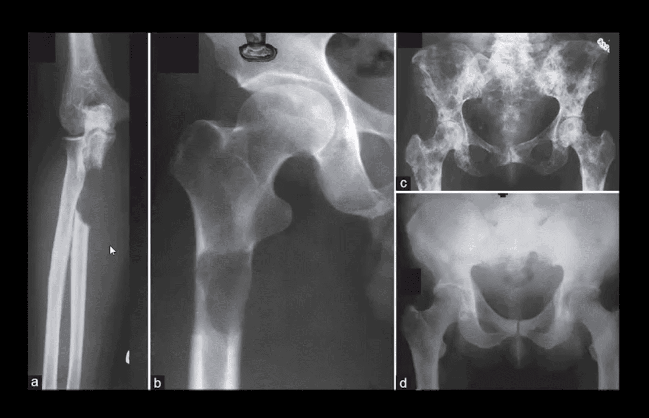 neoplasie spinali diagnostica per immagini el paso tx.