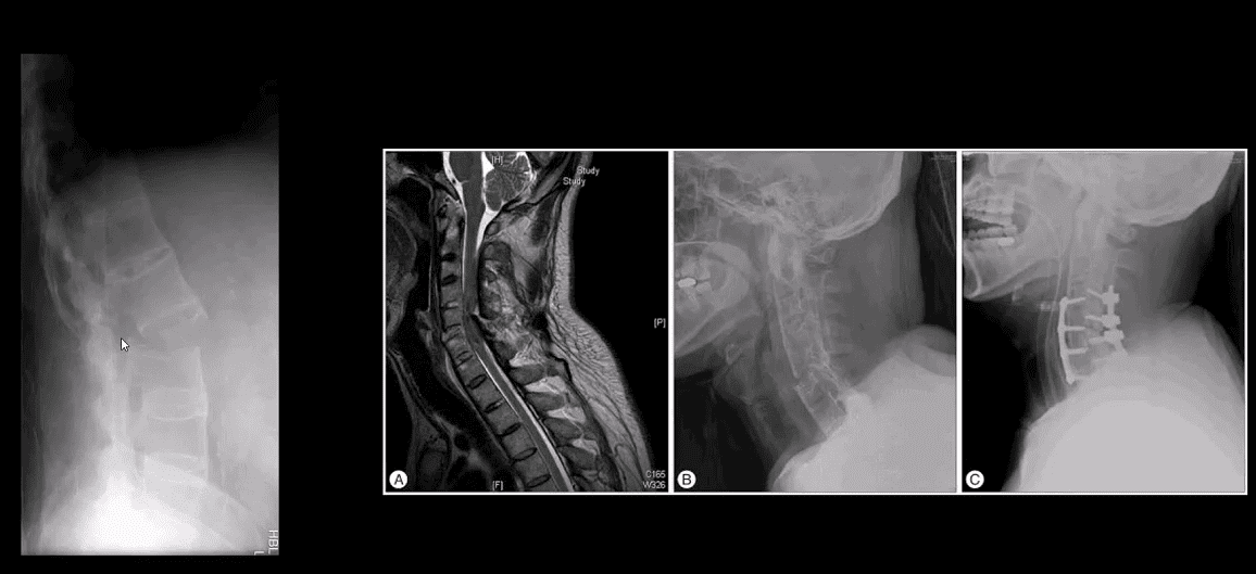 spinal arthritis el paso tx.