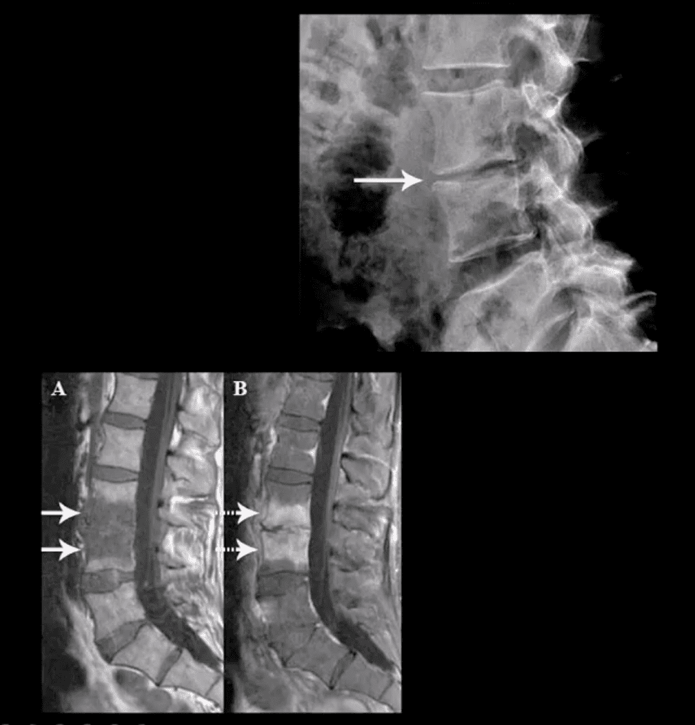 diagnostica per immagini di infezione spinale el paso, tx.