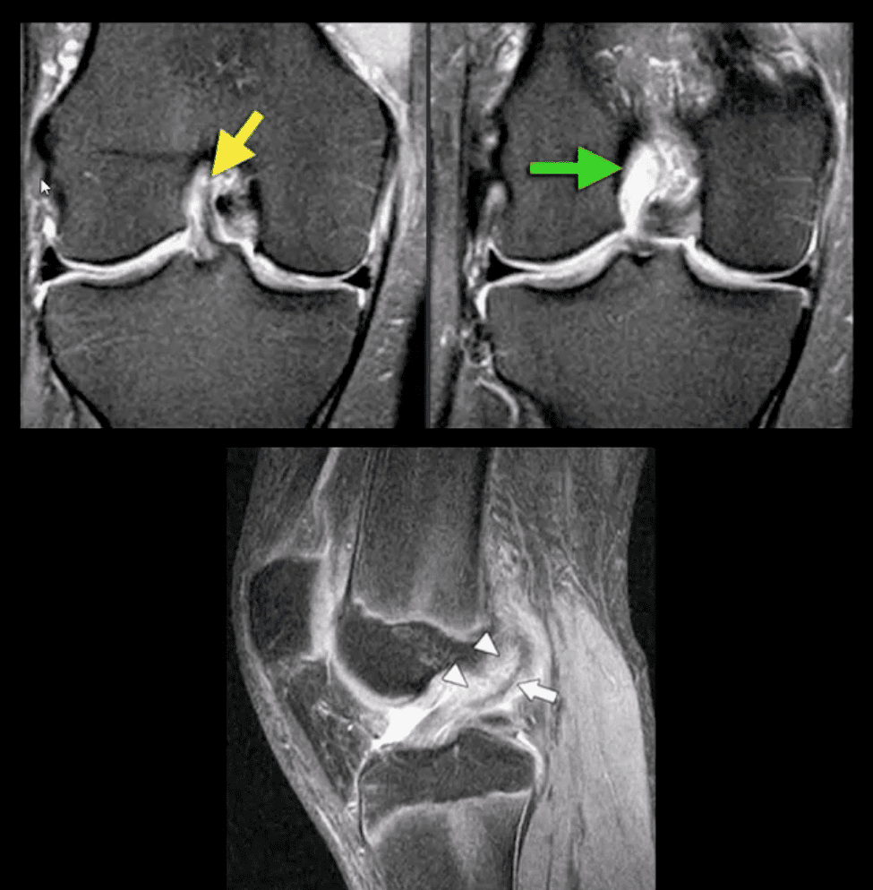 trauma agudo da dor do joelho el paso tx.