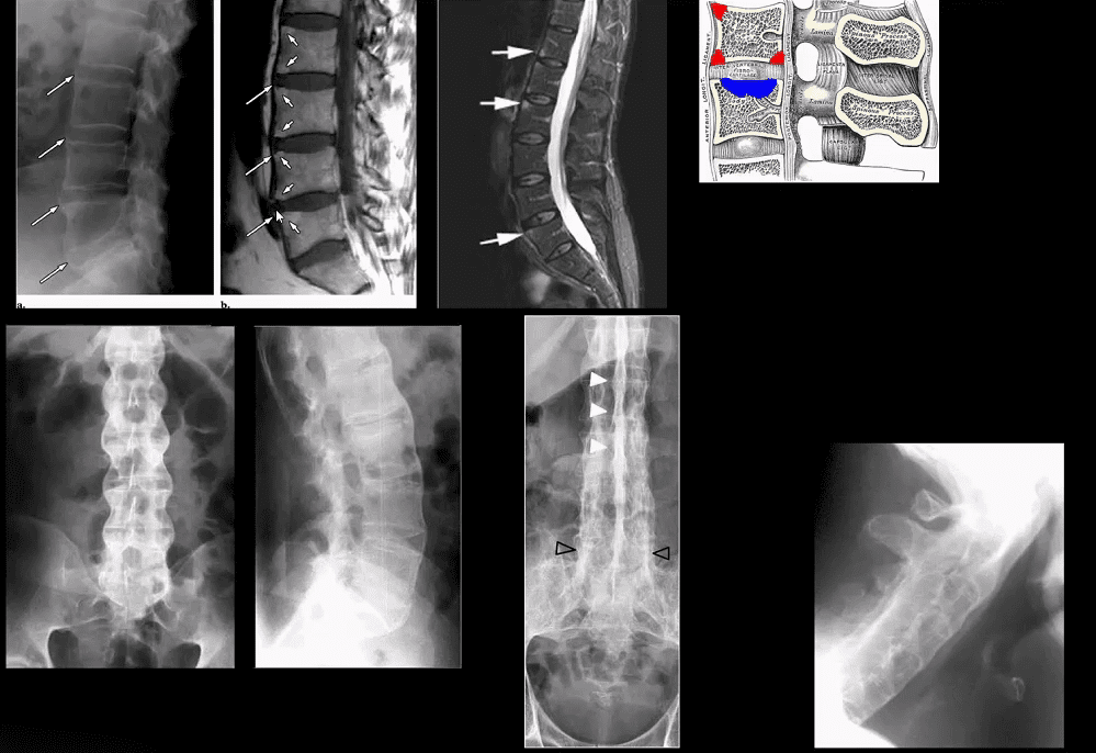 spinal arthritis el paso tx.