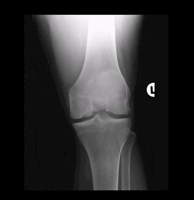 knee pain acute trauma el paso tx.