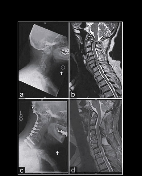 spinal arthritis el paso tx.