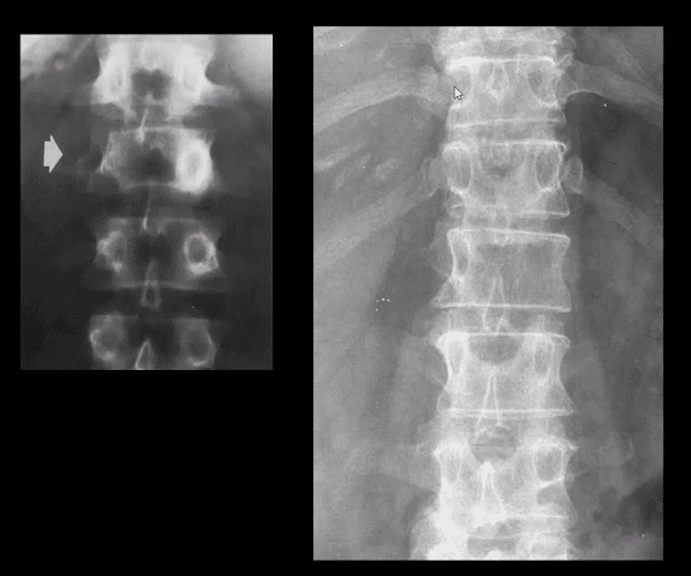 Diagnóstico de las neoplasias espinales el paso tx.