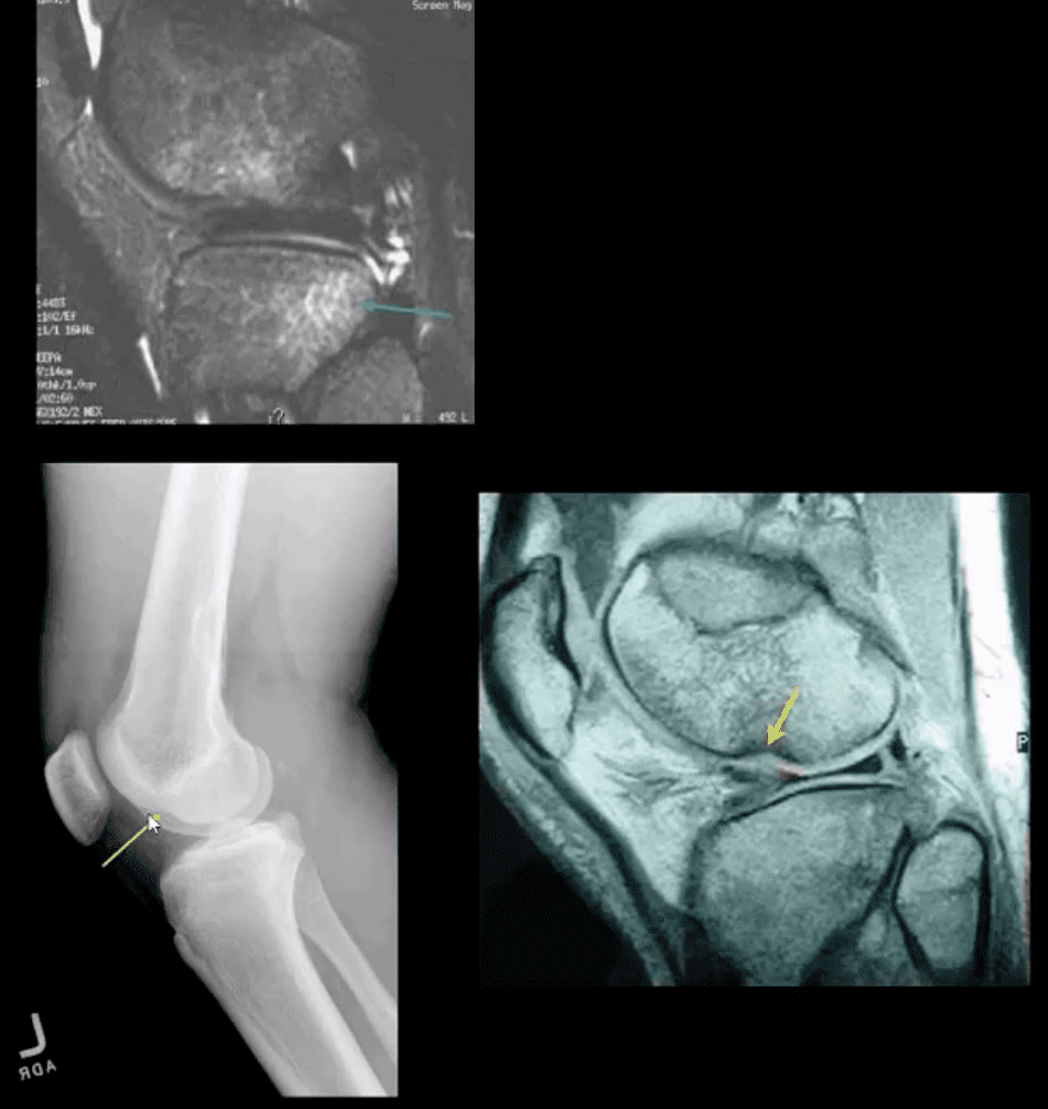 trauma agudo da dor do joelho el paso tx.