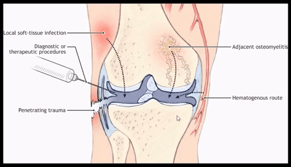 diagnostica per immagini di infezione spinale el paso, tx.