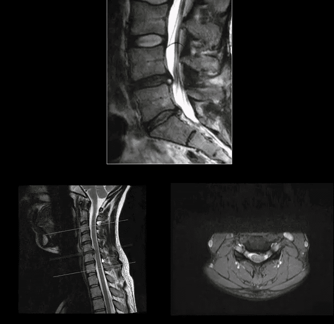 spinal arthritis el paso tx.