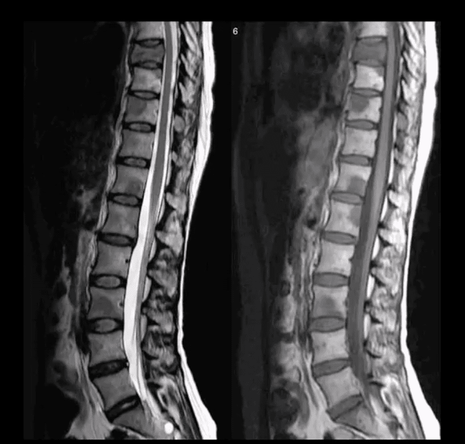 Diagnóstico de las neoplasias espinales el paso tx.