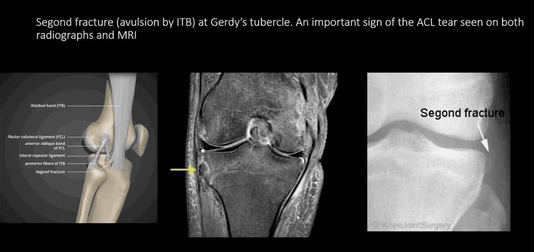 Dolor de rodilla por trauma agudo el paso tx.