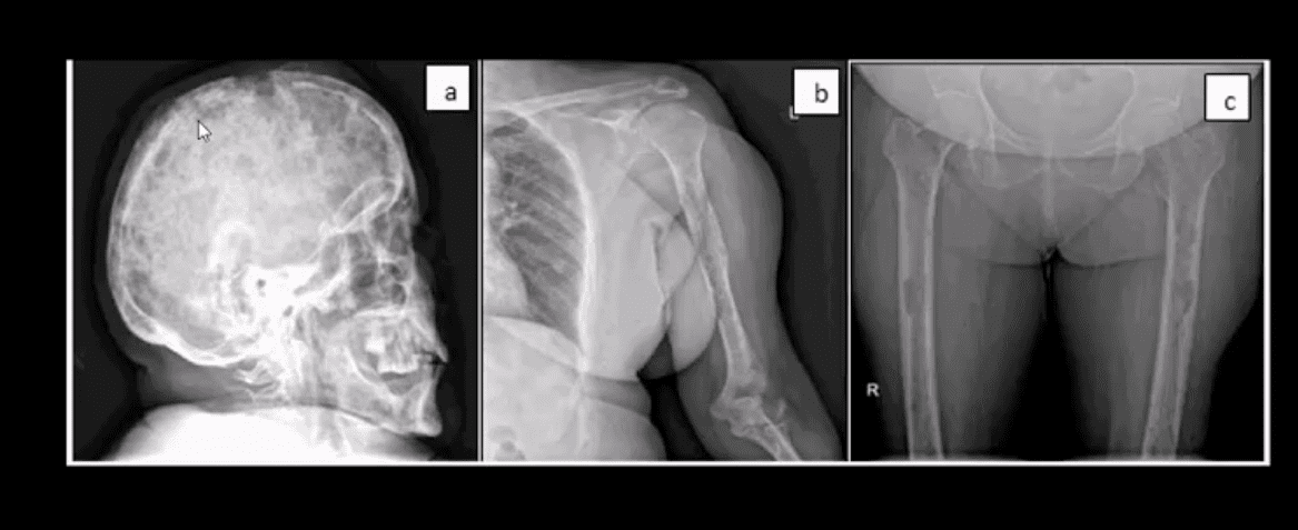 spinal neoplasms diagnostic imaging el paso tx.