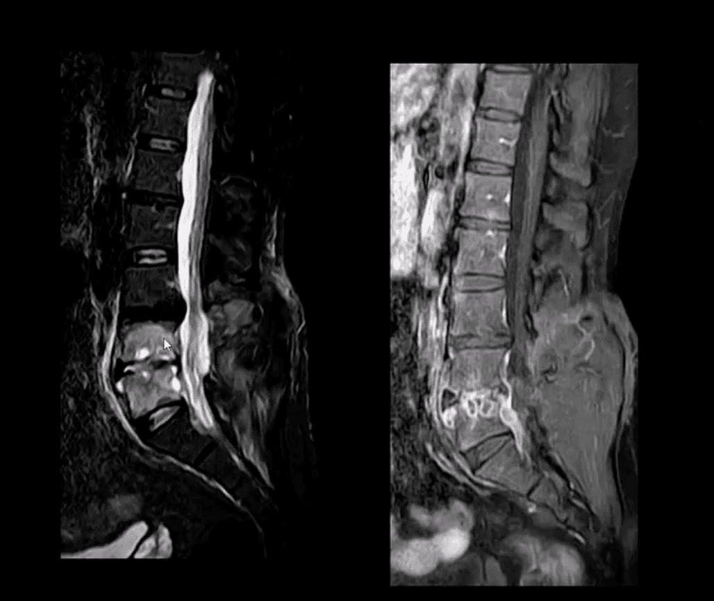 diagnostica per immagini di infezione spinale el paso, tx.