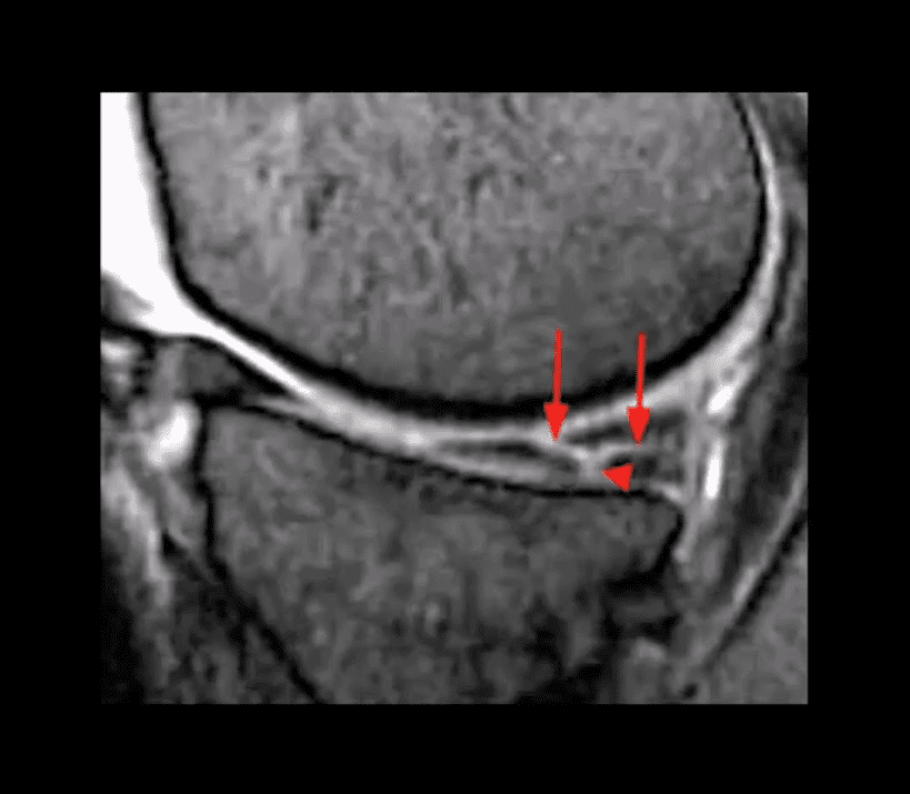 dolore al ginocchio trauma acuto el paso tx.