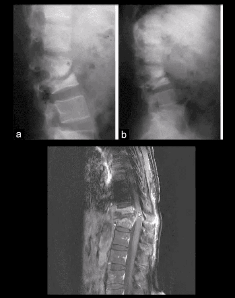 diagnóstico de infección espinal diagnóstico por imágenes el paso, tx.