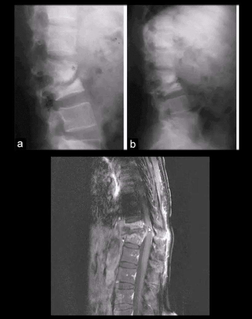 diagnostica per immagini di infezione spinale el paso, tx.