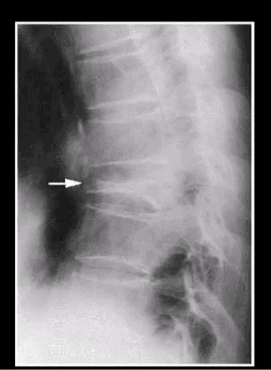 diagnóstico de neoplasias espinales o paso tx.