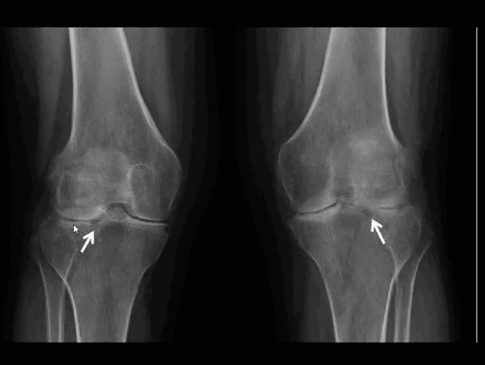 knee arthritis chiropractic care el paso tx.