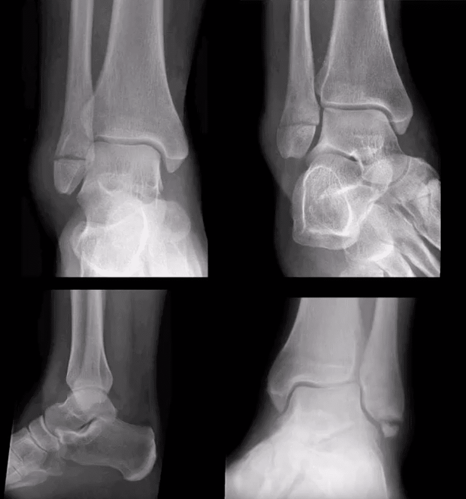 ankle foot arthritis ug trauma el paso tx.