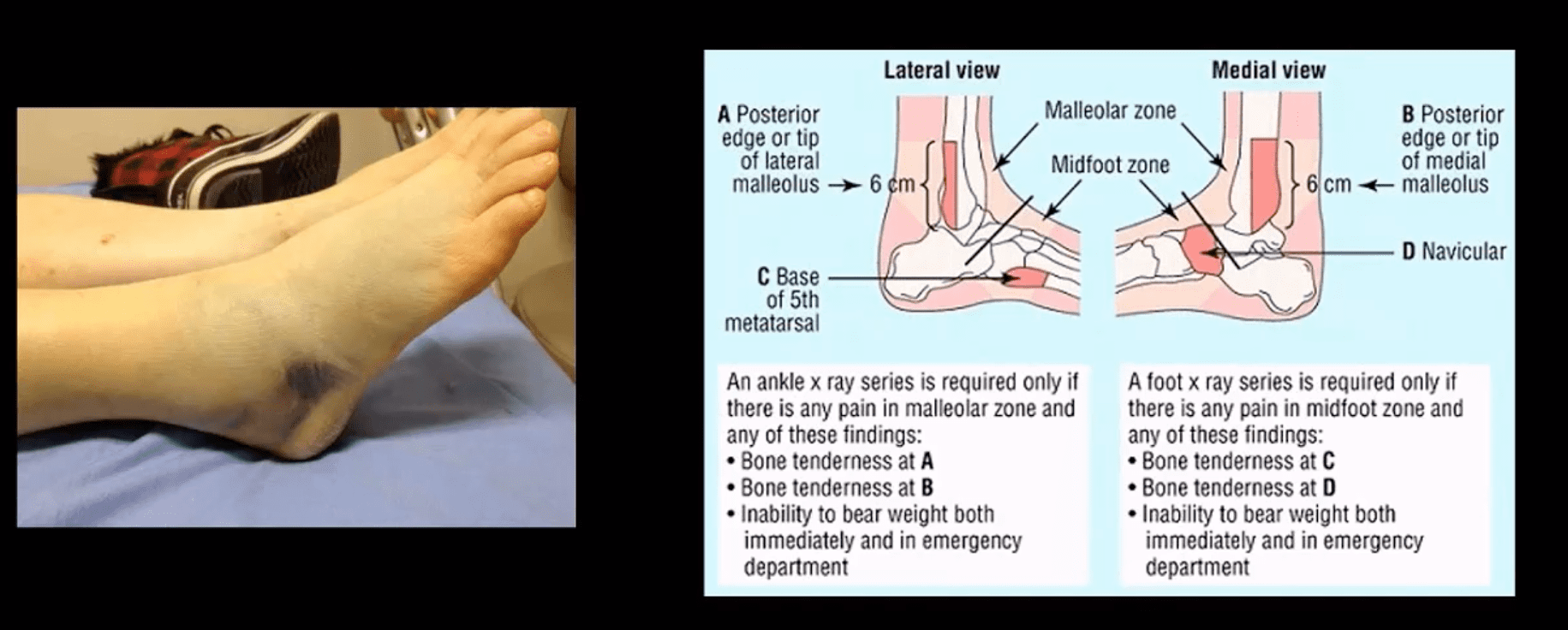 ankle foot arthritis dan trauma el paso tx.