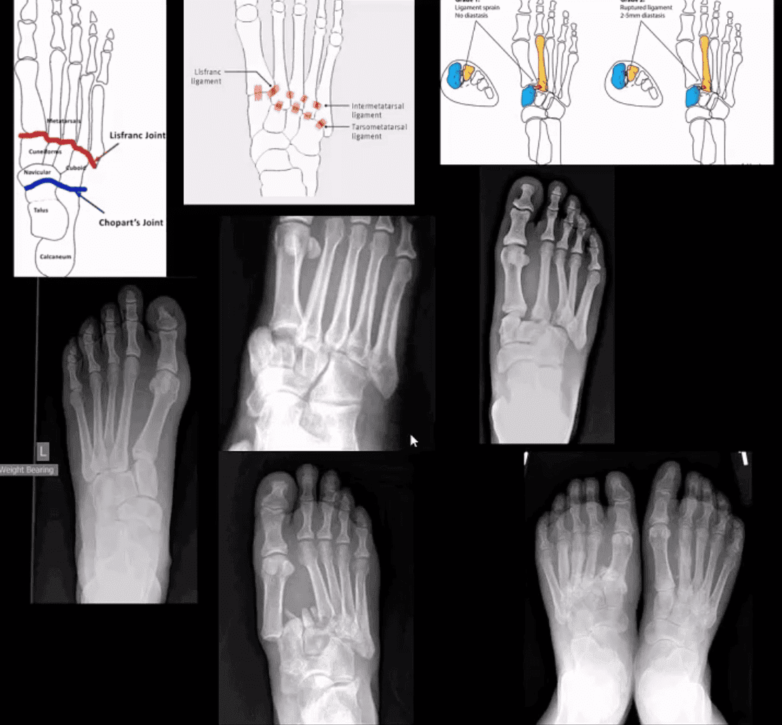 ankle foot arthritis ug trauma el paso tx.