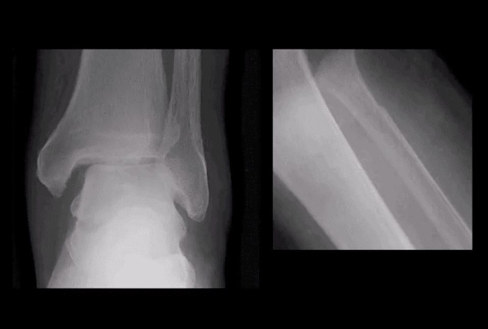 Arthritis cagta canqowga iyo dhaawaca el paso tx.