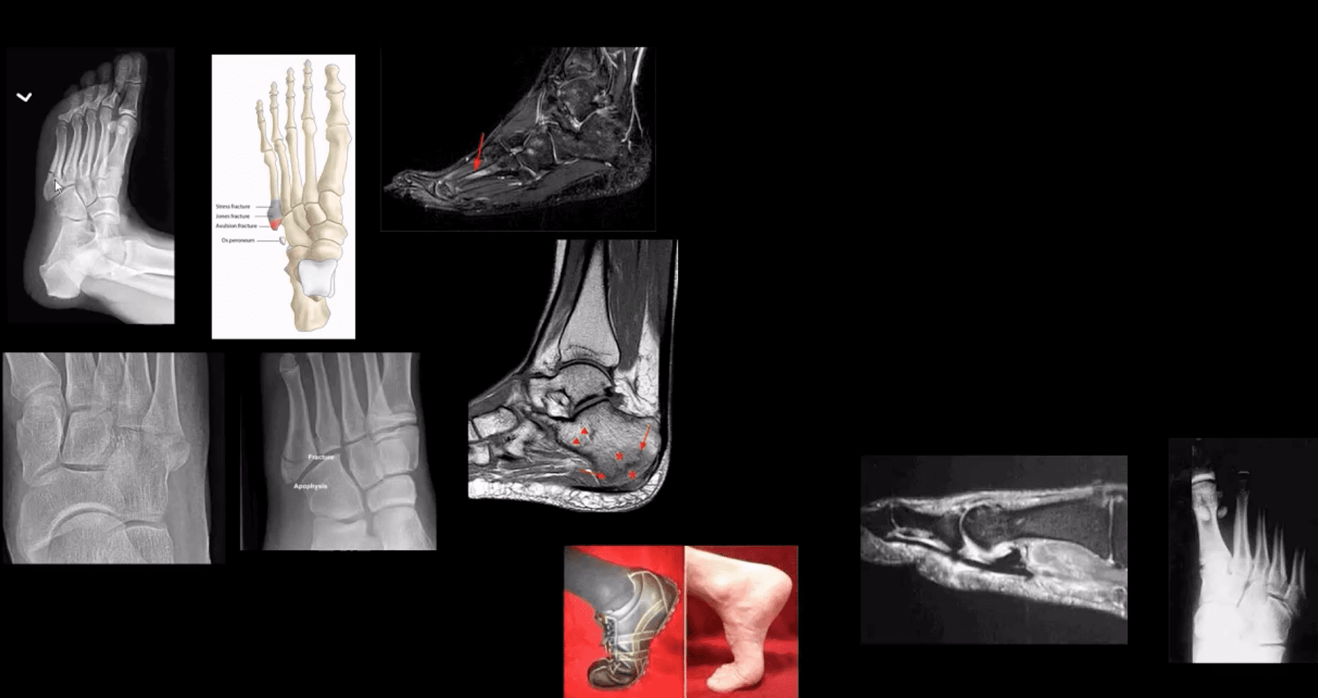 Arthritis cagta canqowga iyo dhaawaca el paso tx.