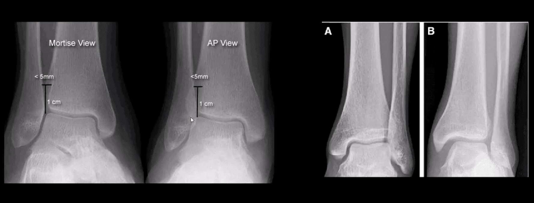 ankle foot arthritis and trauma el paso tx.