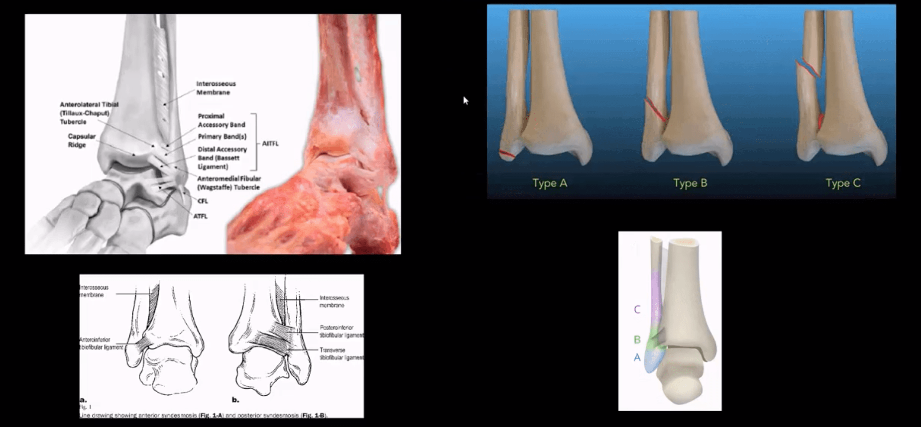 ankle foot arthritis and trauma el paso tx.