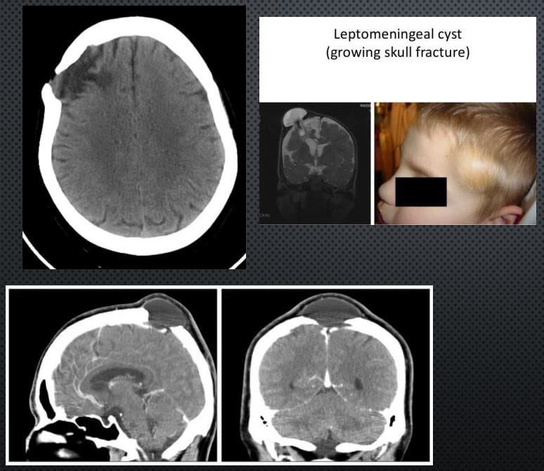 traumatismo cranioencefálico el paso tx.