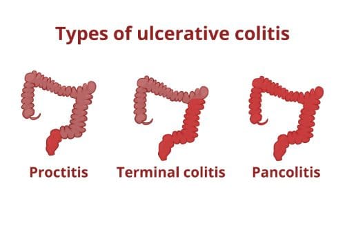 colitis ulcerosa kiropraktisk pleje el paso, tx.