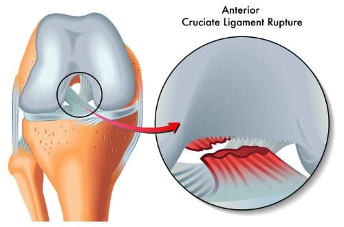 acl injuries chiropractic treatment el paso tx.