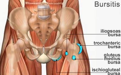 Diagrama de la bursitis | El Paso, TX Quiropráctico