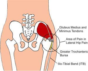 Diagramma di tendinopatia media glutea 2 | Chiropratico di El Paso, TX