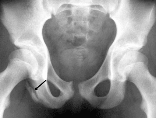 Lesión proximal del tendón de la corva X Ray 1 | El Paso, TX Quiropráctico
